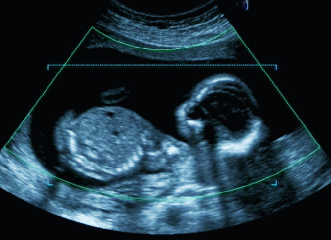 Early detection of serum progesterone levels, key in frozen embryo transfer