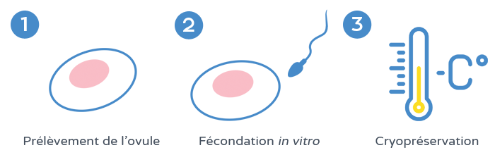 Préservation de la fertilité - Cryopréservation d’embryons