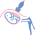 Diagnostic prénatal - Biopsie du chorion