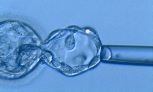 DPI - Biopsie d'embryon réalisée au stade blastocyste